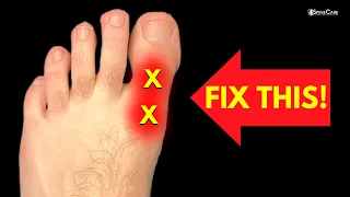 How to Fix BIG TOE Pain for Good