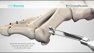 Minimally Invasive Bunion Surgery with CrossRoads MINIBunion™ System - Surgical Animation