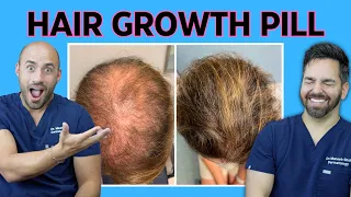 "NEW" Cure for Hair loss | Doctorly Reviews ORAL MINOXIDIL