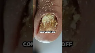 His toenail LIFTED because of the damage!! 🦶