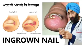 अंदर की ओर बढ़े पैर के नाखून का इलाज | Ingrown Nail | Nail Problem | Home Remedy | Dr.Education