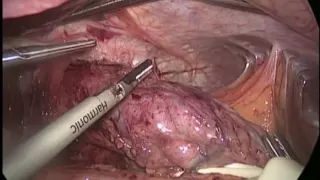 Laparoscopic Gastric Seromyotomy & Conversion to Roux-en-Y Gastric Bypass