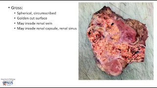 Kidney: Renal cell carcinoma Microscopy - Talking slide
