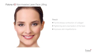 FOTONA 4D LASER for Non Invasive Face Lifting & Skin Tightening