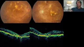 Lecture:  Diabetic Retinopathy: Update on Medical and Surgical Management