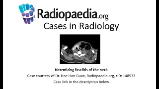 Necrotizing fasciitis of the neck (Radiopaedia.org) Cases in Radiology