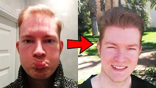 Back From The Dead Hair Loss Reversal - Age 26 To 28