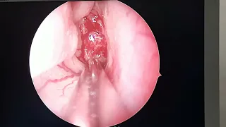 Adenoid removal s md siddique mmc ENT surgery