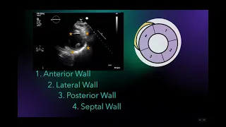 Anteroseptal hypokinesia