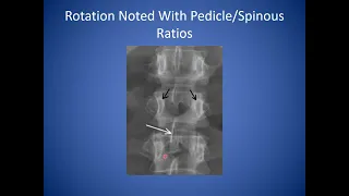 How to Read a Lumbar Spine X-ray | Reading Standing Spine X-ray