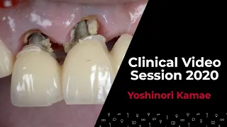 Contemporary new Implant protocol w/ Yoshinori KAMAE | Clinical Video Session 2020
