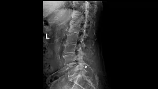 Bone tumor lumbar spine. MRI versus x-ray | First Look MRI