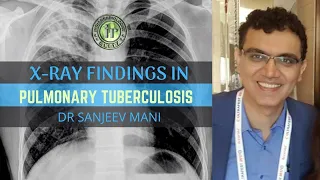 PULMONARY TUBERCULOSIS - X-RAY FINDINGS | DR SANJEEV MANI | MILIARY MOTTLING | ROLE OF IMAGING IN TB