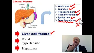 Liver Cirrhosis [1]  #internal_medicine #cme #medicaleducation #ecg #محاضرات_باطنة #medical