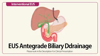 EUS Antegrade Biliary Drainage