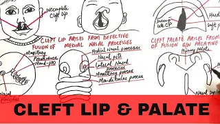 Cleft Lip and Palate - Pathophysiology, Causes & Management