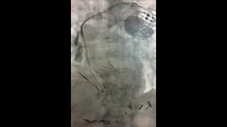 His bundle pacing for complete heart block following a TAVR procedure