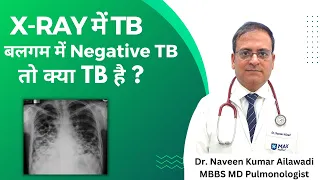 X-RAY में TB बलगम में Negative TB तो क्या TB है ?  #tb #tuberculosis 8368988131 Savelungcenter.com