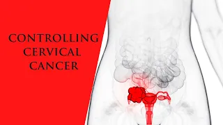 Controlling Cervical Cancer
