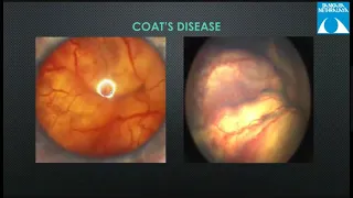 Retinoblastoma, Dr Meenakshi Mahesh, 15 Sep, 2020