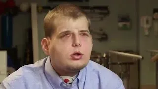 Firefighter receives extensive facial transplant surgery