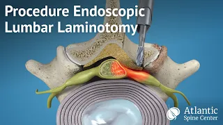 Procedure Endoscopic Lumbar Laminotomy