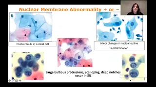 How to report ASCUS, LSIL,HSIL and SCC In PAP screening | cervical cytology part 2 | Bathesda System