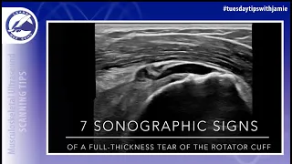 7 Sonographic signs of a full-thickness tear of the rotator cuff