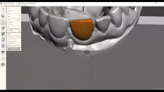 Virtual tooth extraction and ovate pontic site creation using Autodesk MeshMixer