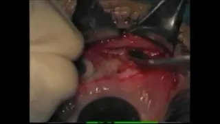 Orbital Floor Fracture Repair with Conjunctival Approach