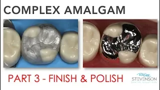 Complex Amalgam - Finishing & Polishing | Part 3