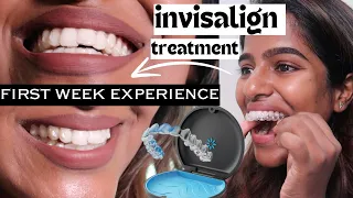 Starting off my invisalign journey!First week experience-Aligners for my crooked teeth-Pros/Cons