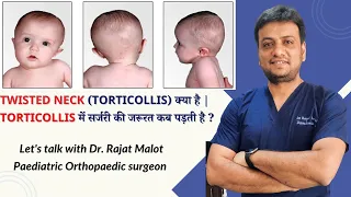 Twisted Neck (Torticollis) क्या है | Torticollis में सर्जरी की जरूरत कब पड़ती है ?