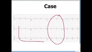 Amal Mattu's ECG Case of the Week_ Sept 15, 2014