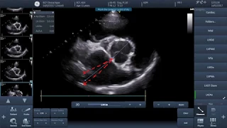 Video 1 - How to perform basic echocardiographic measurements - LAAo