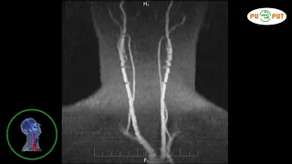 Что покажет МРТ сосудов шеи (снимки МР ангиографии шеи) видео