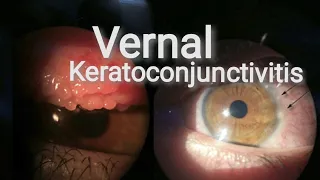 Vernal keratoconjunctivitis | Spring catarrh... Part. 8