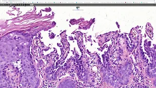 Acantholytic acanthoma, Phillip McKee, Antonina Kalmykova, CSD Health Care