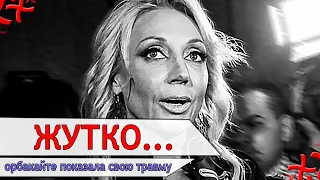 Кристина Орбакайте показала свою травму !! Поклонники очень шокированы !!!