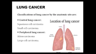 Lung cancer