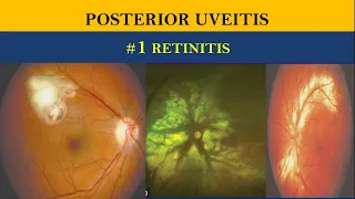 POSTERIOR UVEITIS | retinitis v/s choroiditis