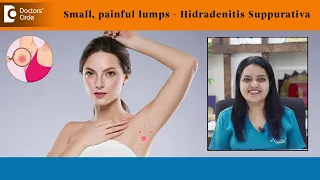Small PAINFUL LUMPS in body folds | HIDRADENITIS SUPPURATIVA - Dr. Urmila Nischal | Doctors' Circle