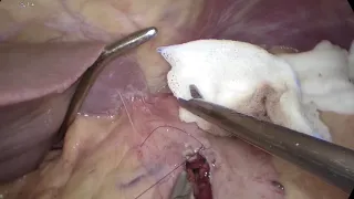 Removal of migrated GastricBand through the gastrotomy