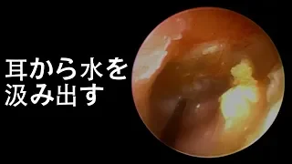 Relaxing Earwax Removal -- Pump Out Water Out Of Ear