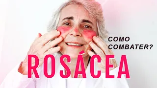 ROSÁCEA: O que é? Como cuidar? Qual o Tratamento? Dicas como combater e ficar livre!