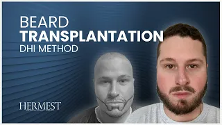 Barttransplantation Türkei Vorher Nachher 1.Tag-365.Tag (durchlauf)