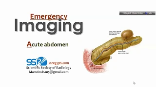 3 Acute Abdomen -  Prof.Mamdouh mahfouz (2019 edition)