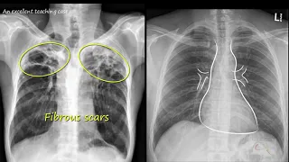 Chest  x ray  -   Tuberculosis healed,  (TB),   Inactive TB