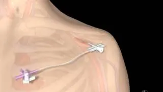 Animated view of how a lead is placed for a pacemaker