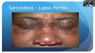 Lecture: Sarcoidosis and Tuberculous Uveitis